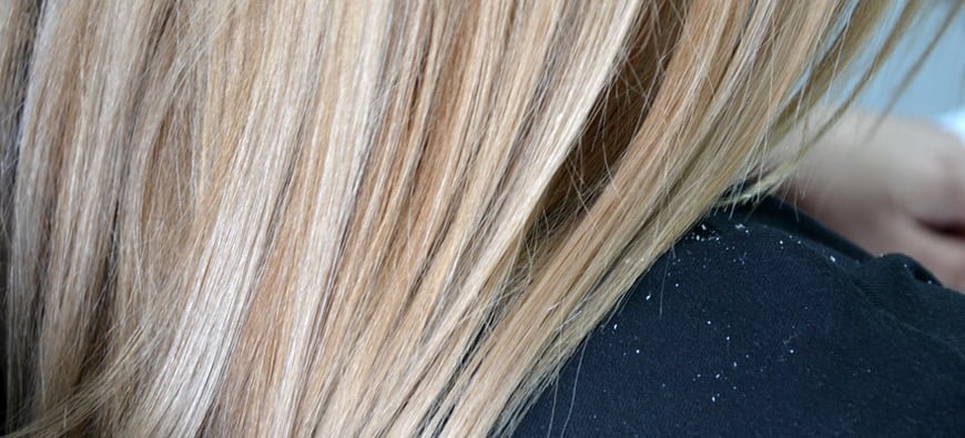 Łupież - jak z nim walczyć